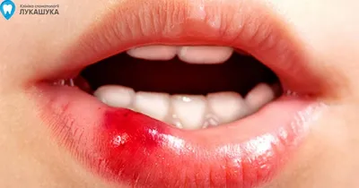 Ретенционная киста губы | Детская и семейная стоматологическая клиника  \"Белая Медведица\" | Санкт-Петербург