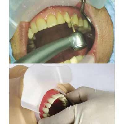 Стоматологический Ретрактор — стоковые фотографии и другие картинки Зубы -  Зубы, Афроамериканская этническая группа, Косметическая стоматология -  iStock