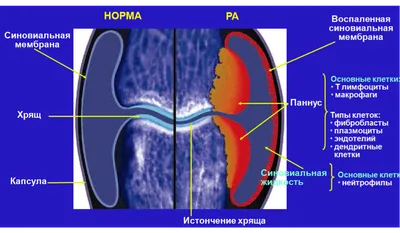 Как лечить ревматоидный артрит? — Пептиды Хавинсона на TenChat.ru