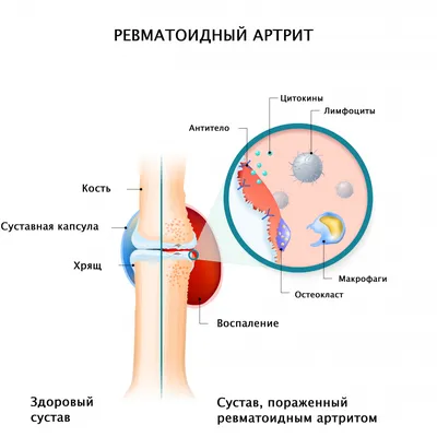 Ревматоидный артрит - причины появления, симптомы заболевания, диагностика  и способы лечения
