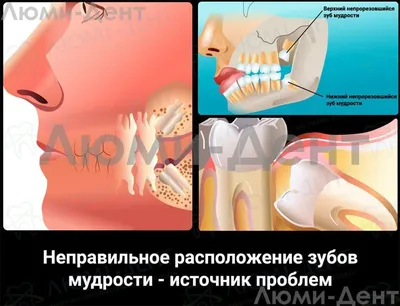 Зуб Мудрости Болит Челюсть Ноет Как Убрать ЛюмиДент
