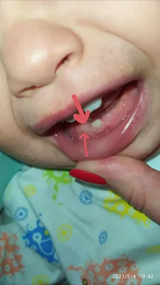 Как режутся боковые нижние резцы? — 24 ответов | форум Babyblog