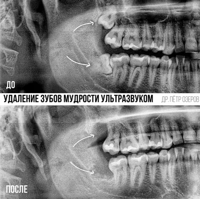 Глазные зубы - это какие, где находятся, симптомы при прорезывании, удаление