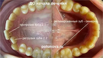 Кривые зубы у детей: причины роста неровных молочных зубов и методы  исправления кривизны