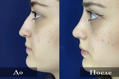 Фото до и после ринопластики - коррекции носа
