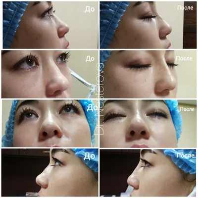 Пользователи интернета подозревают что Чон Чеён соврала насчёт пластики глаз  - YesAsia.ru