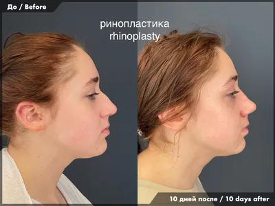Пластика носа в Минске | Медицинский центр Эра