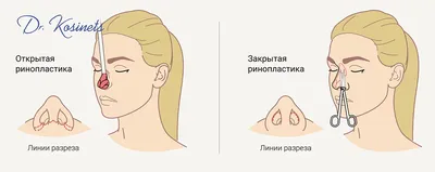 Пластика носа. Ринопластика в Минске | Фото До и После.