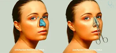 Ринопластика - Сделать пластику носа в Минске по выгодной цене
