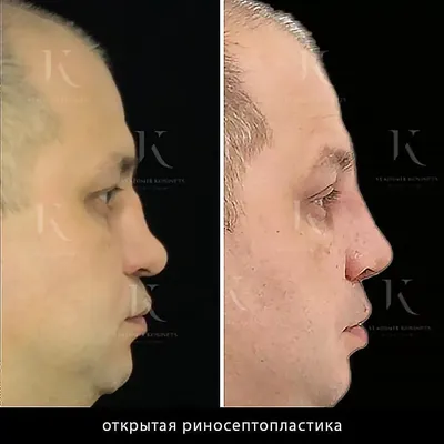 Где в Минске сделать коррекцию формы носа, ринопластику? - Топ Беларуси