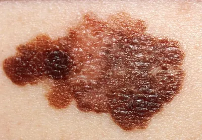 Как отличить рака кожи от меланомы и может ли родинка стать причиной рака -  24 августа 2017 - 59.ру
