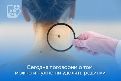 Родинки: как часто проверять и когда удалять - AXEL Clinic