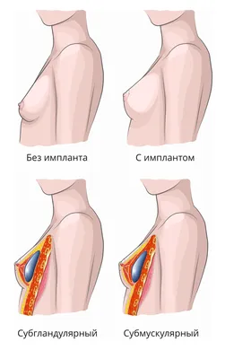 Импланты грудные: что это, виды, формы, размеры, объемы, как выглядят, как  выбрать, способы установки, нужно ли менять