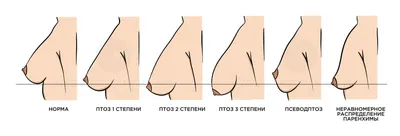 Импланты грудные: что это, виды, формы, размеры, объемы, как выглядят, как  выбрать, способы установки, нужно ли менять