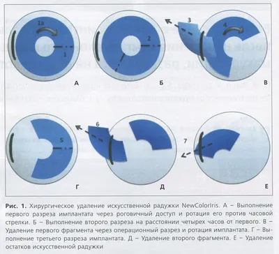 Подтяжка груди на имплантах