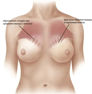Анимационная деформация молочных желёз после маммопластики (увеличения  груди) | Александр Маркушин пластический хирург