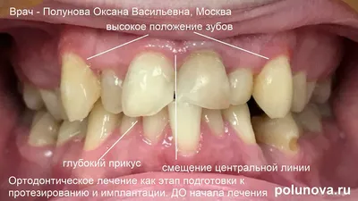 Программа импланты высочайшего качества от компании Polytech, гарантия  качества имплантов Polytech.