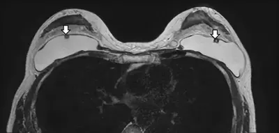 Разрыв силиконового импланта после увеличения груди | Александр Маркушин  пластический хирург