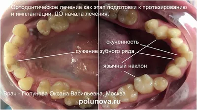 Полиуретановые импланты: плюсы, минусы, особенности