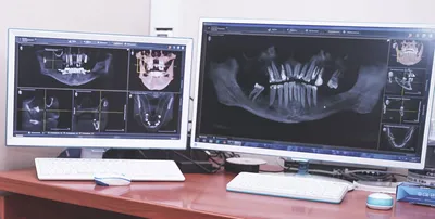 Установка зубных имплантов | Имплантация зубов в стоматологии Лекта Мытищи