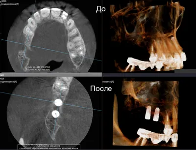 Исправление прикуса как этап подготовки к протезированию и имплантации зубов