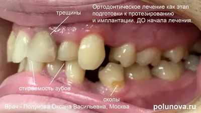 Грудные импланты - Блог проекта OMORFIA