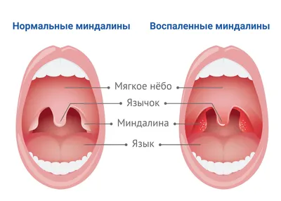 Свищ на десне – причины и лечение - Апекс