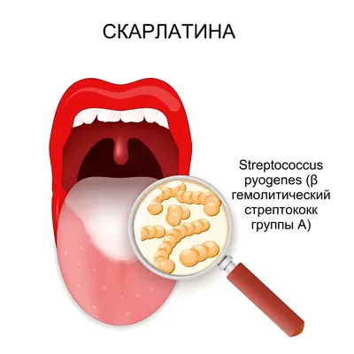 Симптомы и лечение золотистого стафилококка у взрослых и детей — клиника  «Добробут»
