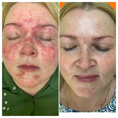 Фото до и после процедуры Лечение розацеа в центре лазерной медицины в  Краснодаре ✨