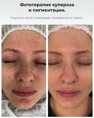 Лечение розацеа на аппарате М22 лицо | Центр красоты «Профессиональная  Косметология»