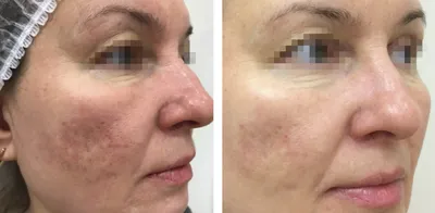 Лечение розацеа на аппарате М22 фотографии до и после, проводим в клинике  Premium Aesthetics