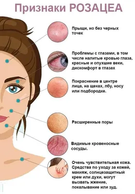 Dr.Moskalenko beauty clinic - Розацеа — хронический воспалительный процесс,  который проявляется как покраснения на коже. Также розацеа провоцирует  появление расширенных сосудов, папул и отеков. У кого-то заболевание  протекает в достаточно спокойной форме