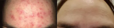 Розацеа на лице лечение фото до и после. Розацеа фото после лечения. Розацеа  до и после лечения фото.