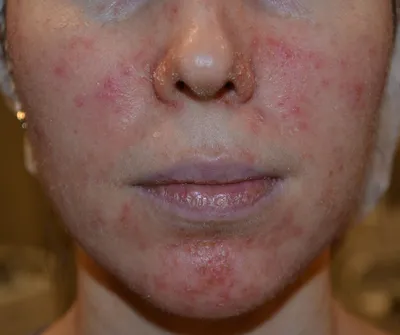 Как удалить купероз на лице: фотоомоложение на аппарате bbl – отзывы |  Beauty Insider