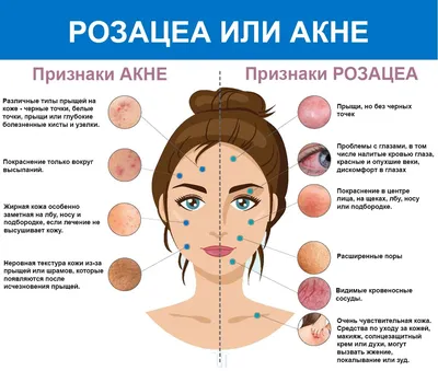 Лечение розацеа на лице в Астане, аппаратное лечение розацеа