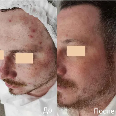 Розацеа на лице лечение фото до и после. Розацеа фото после лечения. Розацеа  до и после лечения фото.