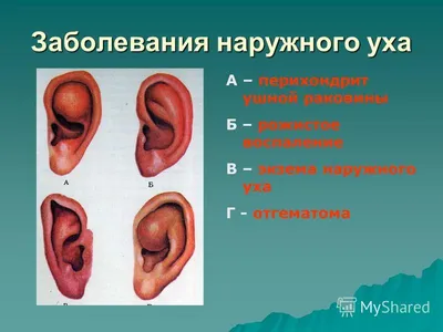 Мы лечим следующие заболевания уха — Амбулаторный центр №1