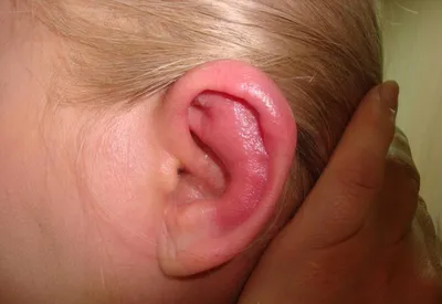 Рожистое воспаление наружного уха.Симптомы - YouTube