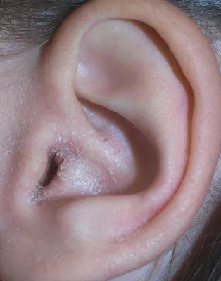 Воспаление ушной раковины, перихондрит наружного и внешнего уха
