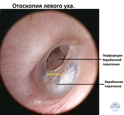 Болезни отдыхающих - диффузный отит, средний отит