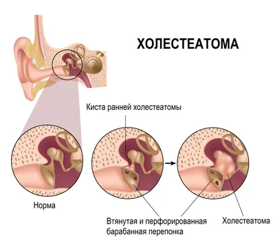 Доброкачественные опухоли уха - причины появления, симптомы заболевания,  диагностика и способы лечения