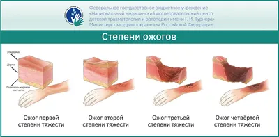 РУБЦЫ ПОСЛЕ ОЖОГОВ У ДЕТЕЙ | НМИЦ детской травматологии и ортопедии имени  Г. И. Турнера Минздрава России | Дзен