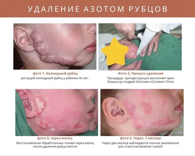 Удаление азотом рубцов и шрамов в Киеве - Coolaser Clinic ?