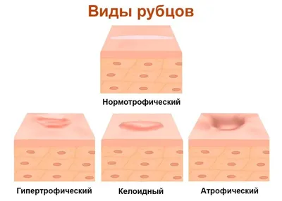 Гипергидроз - как его лечить. Причины заболевания