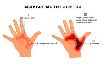 Лазерная шлифовка рубцов, удаление рубцов лазером