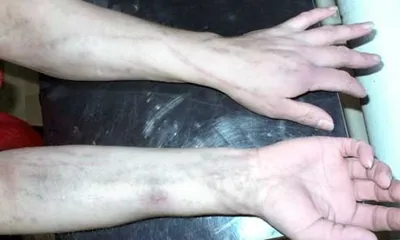 Руки наркомана о изолированном шприце Стоковое Изображение - изображение  насчитывающей давление, внутривенно: 37887665