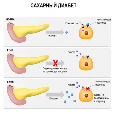 Сахарный диабет (Diabetes, Diabetes mellitus) - причины появления, симптомы  заболевания, диагностика и способы лечения