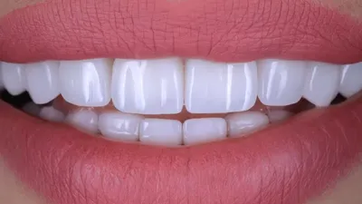 Виниры для зубов можно ставить только при правильном прикусе - клиника  Ортодонтика, Москва