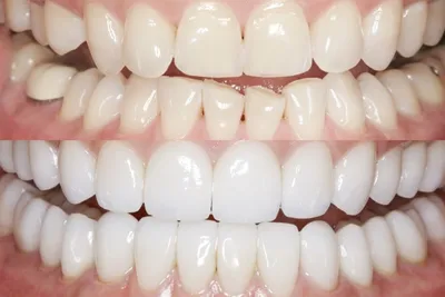 Художественная реставрация зубов, что это? | SILK