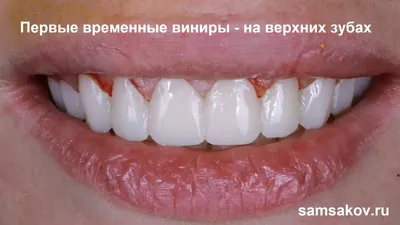 Как вернуть красивые зубы и улыбку после родов - ортопед Самсаков Сергей,  Москва